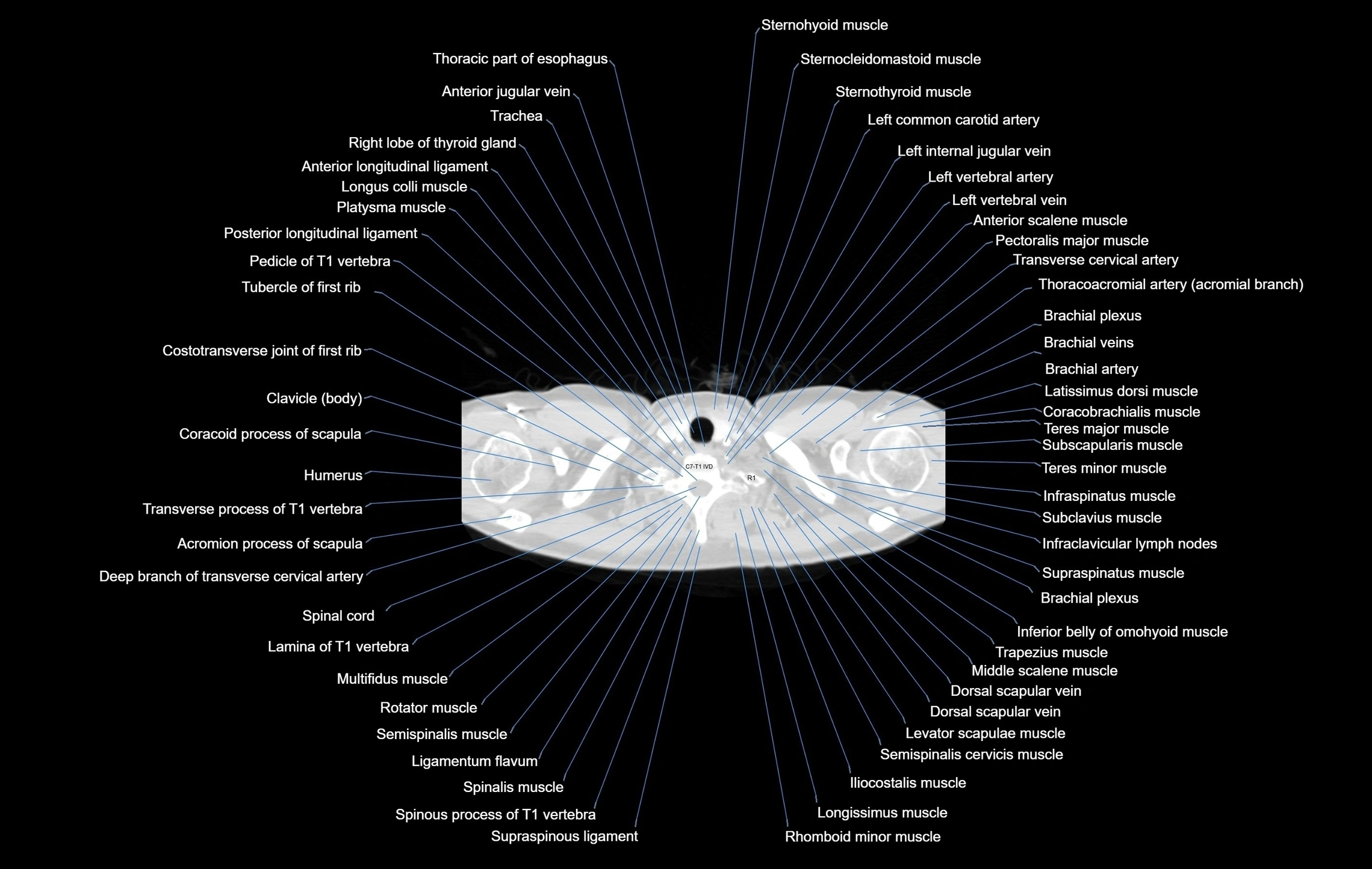 CT chest (thorax) labelled axial cross sectional anatomy radiology image-00001.webp